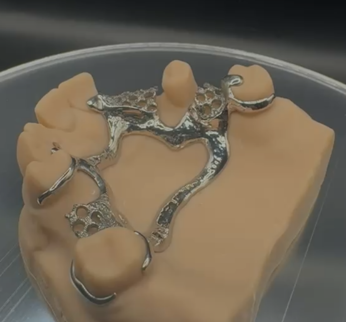 Alternate view of the metal framework and clasp positions on a dental model