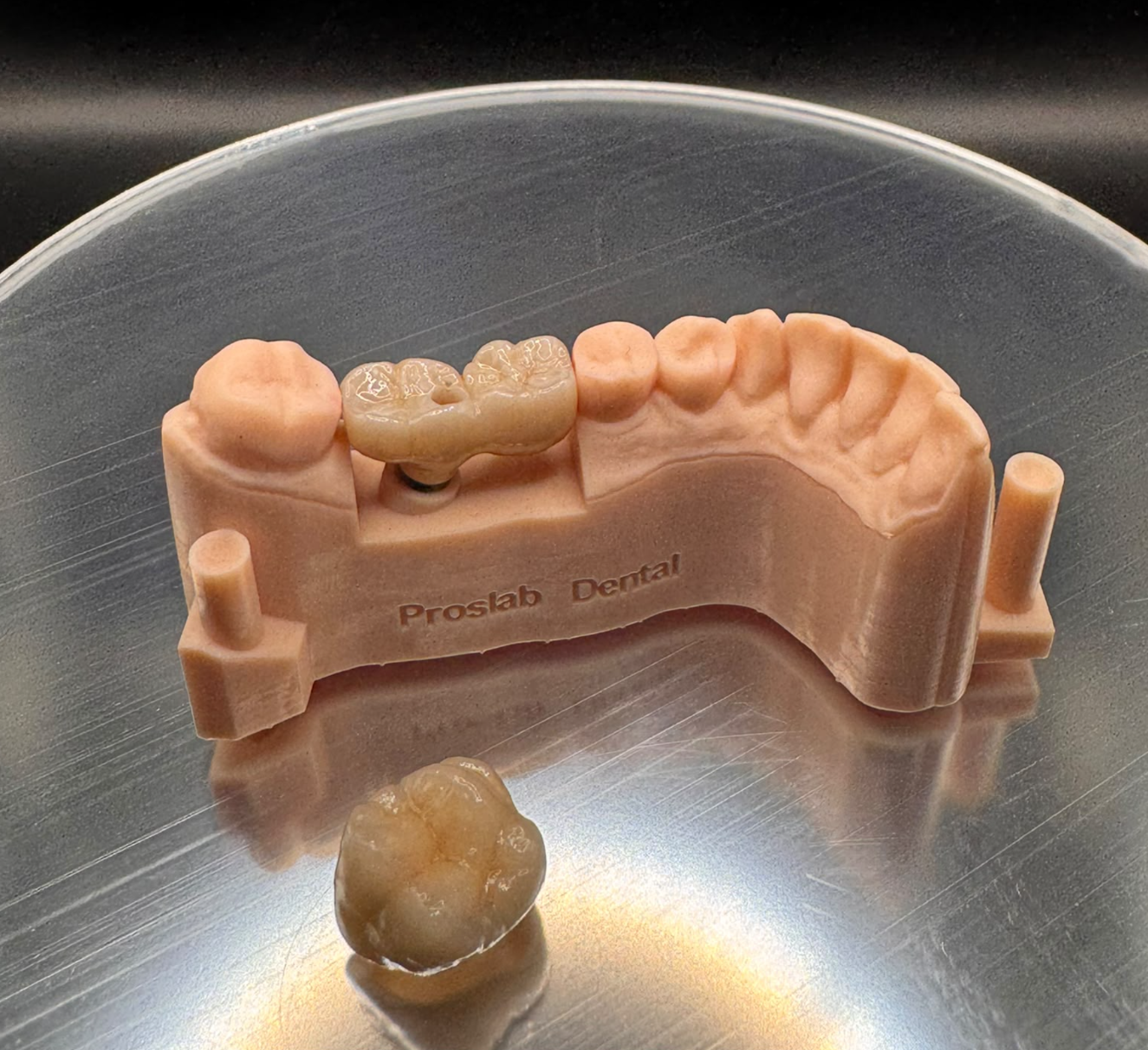 Tooth-coloured bridge with a visible screw-access opening on a Proslab dental model, with a separate crown in front
