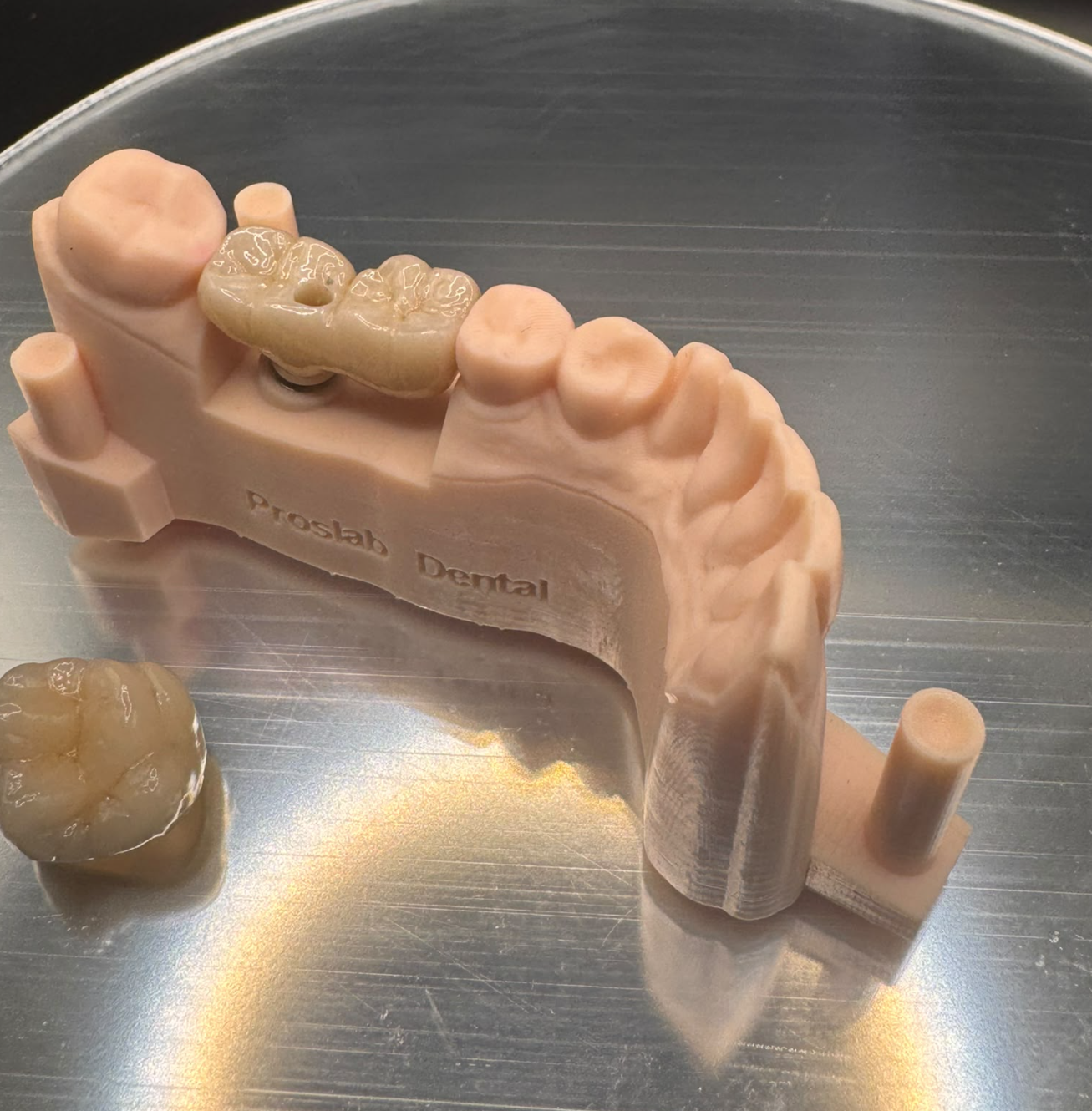 Close view of the bridge and its screw-access opening seated on a dental model