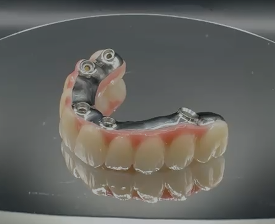 Full-arch restoration showing the teeth, pink base and metal substructure